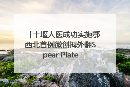 十堰人医成功实施鄂西北首例微创拇外翻Spear Plate髓内板矫形术